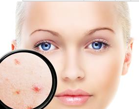 如何徹底地告別痤瘡？試試這些方法