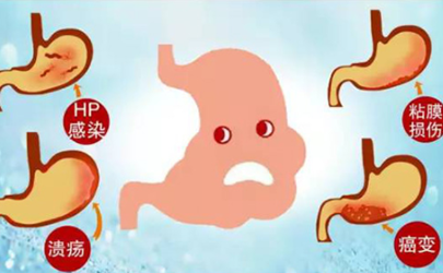 胃癌是不是必須開刀 胃癌癥會(huì)不會(huì)傳染