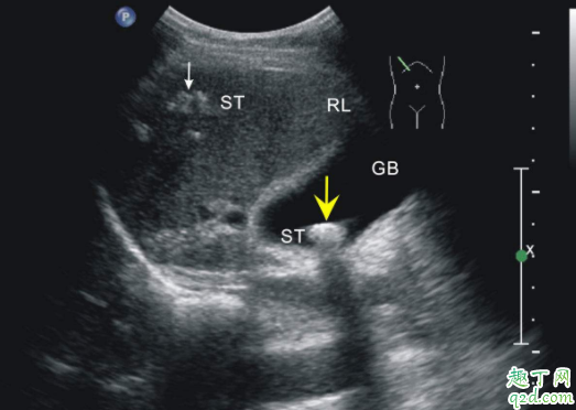 孕36周胎兒顯示頭偏小怎么辦 羊水少了吃什么可以補1