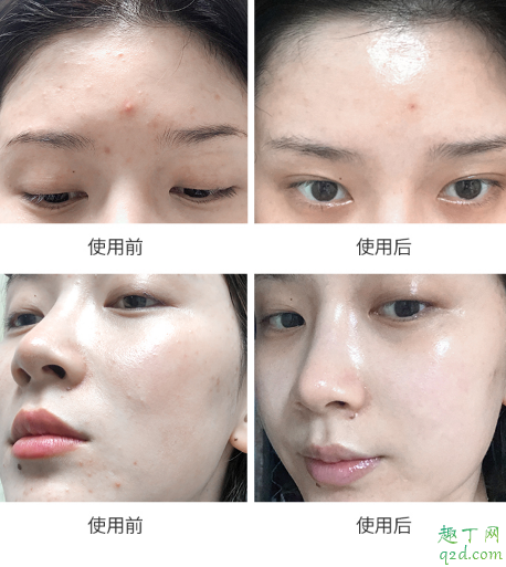 科娜藍(lán)面霜爆痘真的可以修復(fù)好嗎 科娜藍(lán)面霜孕婦能用嗎2