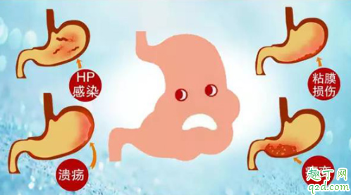 胃癌是不是必須開刀 胃癌癥會(huì)不會(huì)傳染2