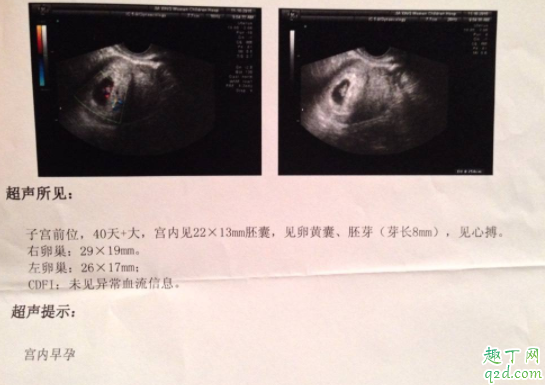 有卵黃囊就一定會(huì)有胎心胎芽嗎 卵黃囊什么時(shí)候能看到3