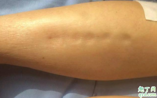 為什么有的孕婦會(huì)水腫 懷孕水腫有影響嗎3