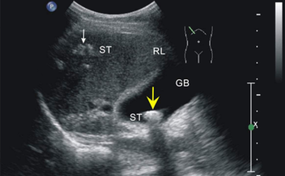 孕36周胎兒顯示頭偏小怎么辦 羊水少了吃什么可以補