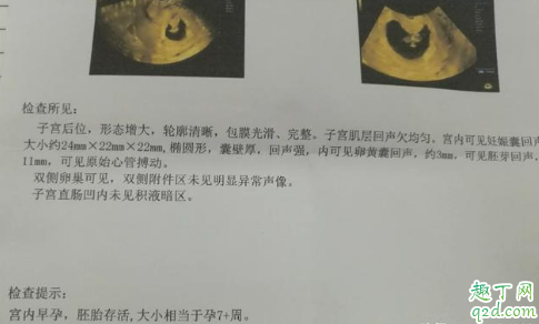 懷孕七周沒有胎心什么原因 懷孕7周肚子有點隱痛怎么回事2